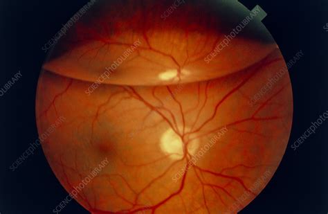 Ophthalmoscopy Of Detached Retina In Patients Eye Stock Image M155