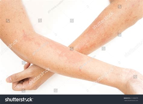 Skin Rashes Allergies Contact Dermatitis Allergic Stok Fotoğrafı