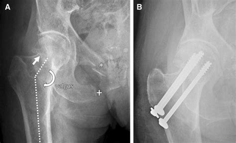 89 Year Old Woman With A Valgus Impacted Femoral Neck Fracture Ap