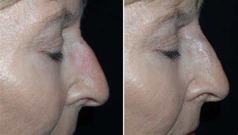 Nose Surgery Richmond Va Filler Rhinoplasty Nose Job Rhiniophyma