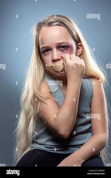 Sad And Frightened Little Girl With Bloodshot Bruised Eyes And False