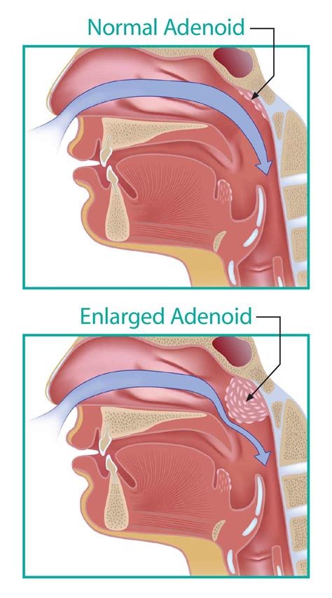 Adenoids Anatomy Anatomical Charts And Posters