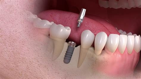 Single Implant With Crown Youtube