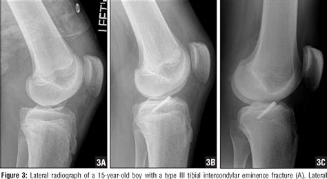 Tibial Intercondylar Eminence