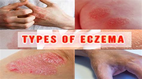 Eczema Two Common Variations In A Gene Called Kif3a Are Responsible