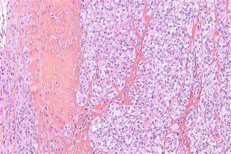 Clear Cell Sarcoma Of Soft Tissue
