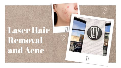 Laser Hair Removal And Acne At Sev Laser Youtube