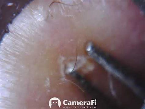 SEE IT POP OUT INFECTED INGROWN HAIR YouTube