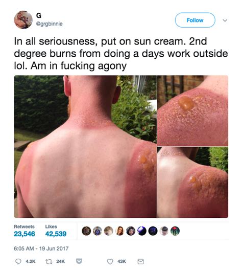 This Mans Sunburn Is Going Viral Reminds Us The Importance Of Sunscreen