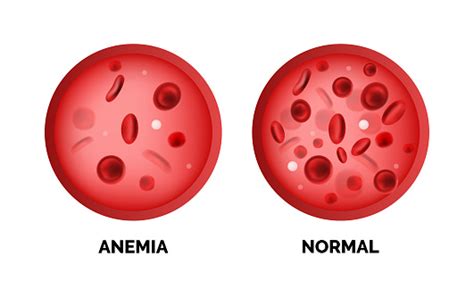 Infographic Image Of Anemia Isolated On White Background Stock