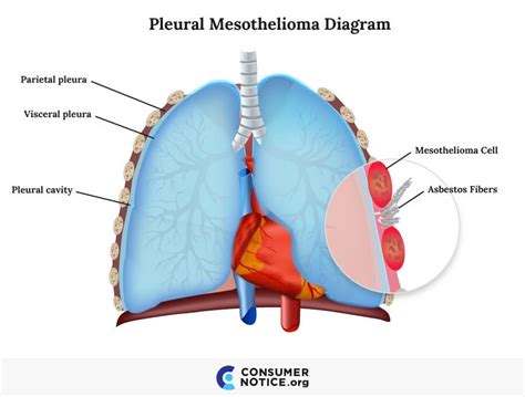 Mesothelioma is a cancer that develops in these linings. Asbestos and Mesothelioma | Symptoms, Stages & Treatments