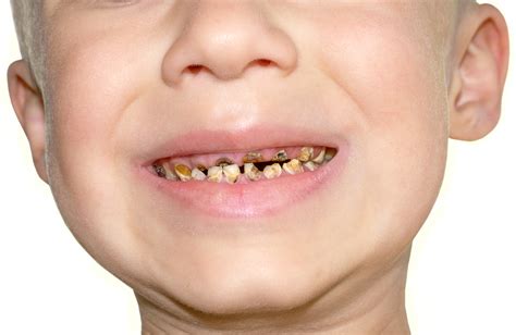 Tooth Decay On The Increase In 5 Year Old Children