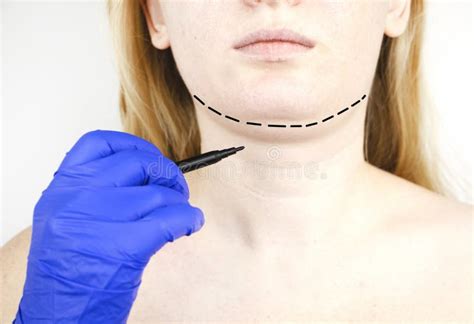 Mentoplasty Barbilla Plástica Paciente Antes De La Cirugía De La
