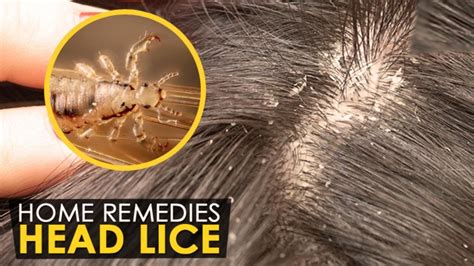 How To Get Rid Of Head Lice In Your Home Youtube