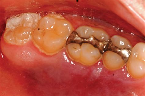 It is the most common form of cancer in aids patients. Case Report: Kaposi Sarcoma
