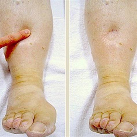 Ayurvedic Treatment For Swollen Legs Yatan Ayurveda