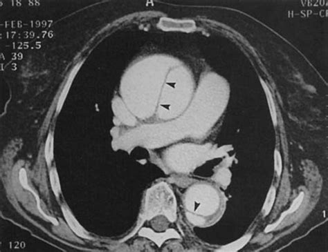 Type A Aortic Dissection At Ct Axial Image From Spiral Ct Scan Reveals