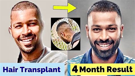 Hardik Pandya Amazing Hair Transplant Result Just In Month