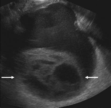 Mucinous Cystadenoma Of Lmp Ultrasound Demonstrates A Large Right