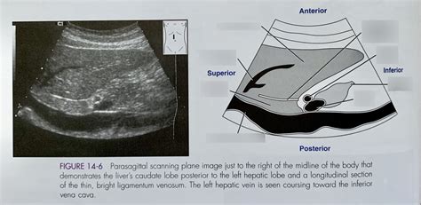 14 6 Demonstrates The Liver S Caudate Lobe Sag Diagram Quizlet