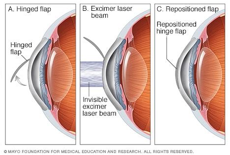 تنتمي فهد المواصلات laser surgery for short sightedness
