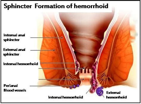 Patients with hemorrhoids usually have a good. Natural herpes relief, relief for hemorrhoids pain ...
