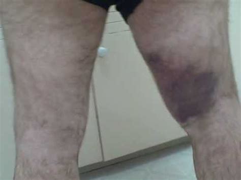 Get information about hamstring injuries (pulled hamstring), including symptoms, causes, treatment, and prevention. Pulled Hamstring - YouTube
