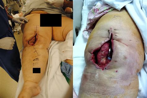 Maybe you would like to learn more about one of these? Flap Surgery: Autologous Tissue, Wounds, Microvascular ...
