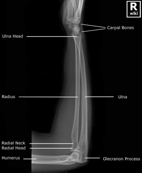 Radiographic Anatomy Of The Forearm Radiology Student Radiology