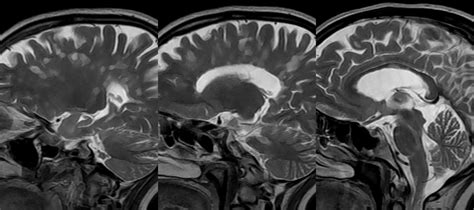 Multiple Sclerosis Mri Flair Hot Sex Picture