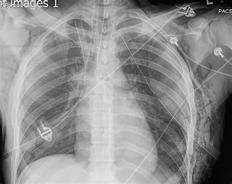 Tension Pneumothorax Chest Tube Placement Porn Sex Picture