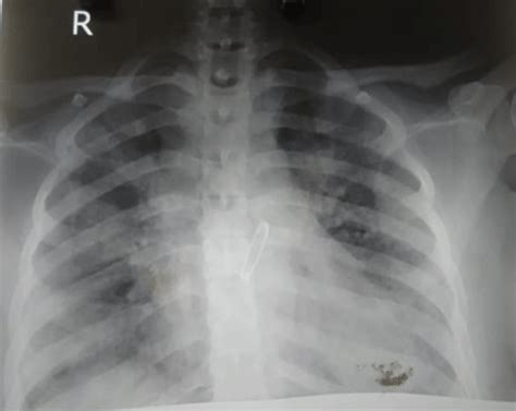 Anteroposterior View Of Chest X Ray Shot On 1st Day Of Hospitalization