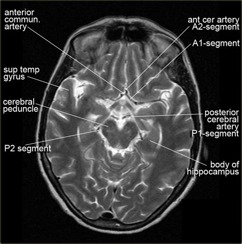 Ct Scan Brain Anatomy Ct Scan Anatomy Of Brain Anatomy Drawing Diagram This Article Will