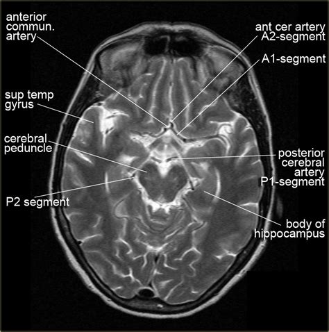 Neck Anatomy Diagram Ct Anatomy Of Neck Anatomy Drawing Diagram My Xxx Hot Girl