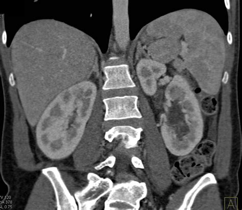 Duplicated And Dilated Left Renal Pelvis Collecting System And Ureter