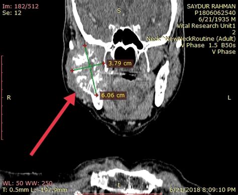 Sclerotic Bone Lesions Radiology Ct Bony Destruction Left