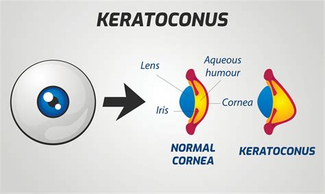 What To Know About Keratoconus And Corneal Cross Linking See Clearly