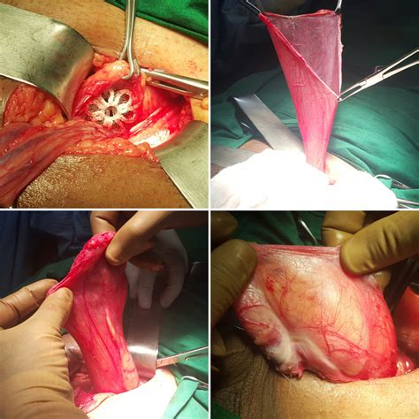 Herniasurgeryclinik 3 D Hernia Surgery Of Groin Inguinal Hernia