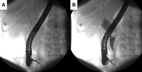 Ercp Cannulation Of The Major Papilla Hooded By A Redundant Kerckrings