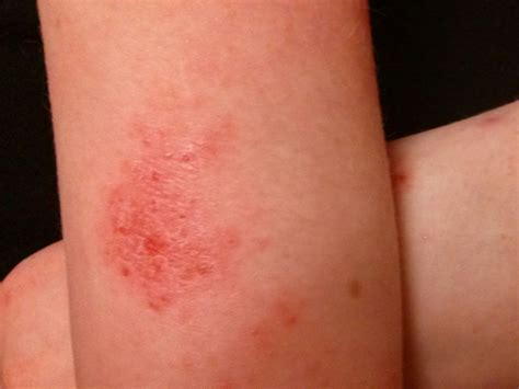 Eczema Affects More Than The Skin
