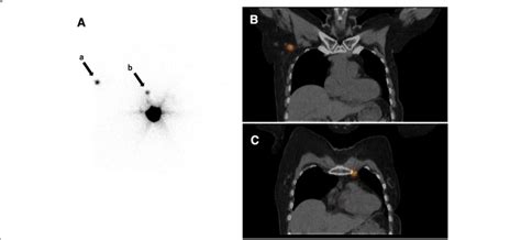 Lymphoscintigraphy And Spectct Images Of Aberrant Lymphatic Drainages