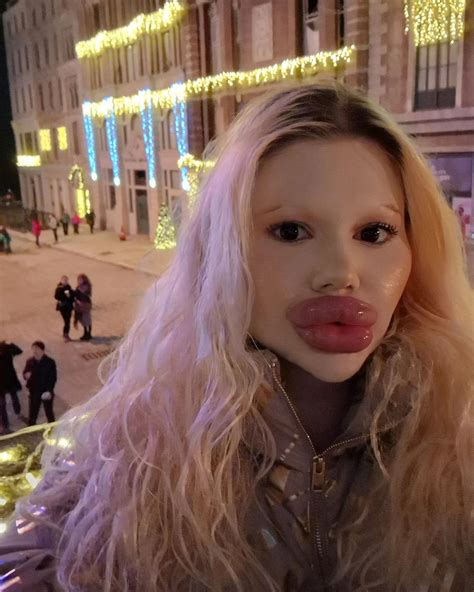 Andrea Ivanova The Woman With The Worlds Largest Lips Got 6 Injections In One Day Despite The