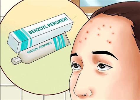 How To Get Rid Of Forehead Acne Forehead Acne Pimples On Forehead