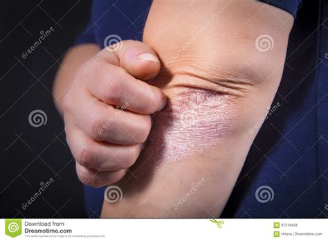 Dermatite dermatology diagnóstico doença disorder secar seco secos eczema cotovelo humano ser humano doente imune imunológico isento. Psoríase no cotovelo foto de stock. Imagem de vermelho ...