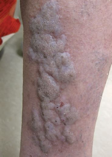 An Atypical Presentation Of Unilateral Linear Hypertrophic Lichen