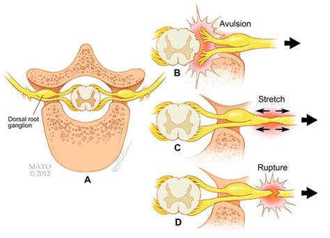 Brachial Plexus Injuries Orthoinfo Aaos