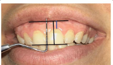 The Photograph Of The Smile With Excessive Gingival Display Before