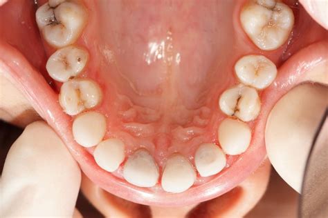Hard Lump On Lower Gum What Doctors Want You To Know