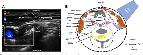 Figure 1 From Efficacy Of Ultrasound Guided Intermediate Cervical