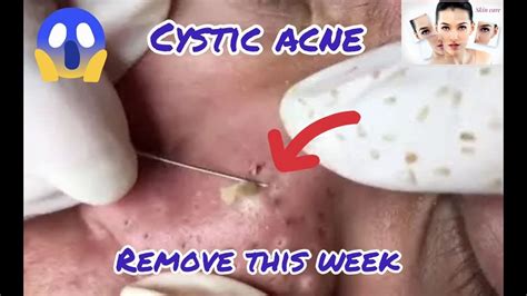Cystic Acne Extraction This Week Blackheads Remove Pimple Popping 23